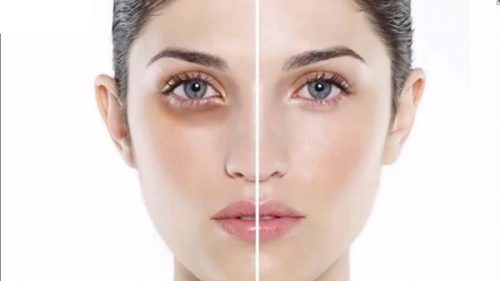 Bọng mắt dấu hiệu lão hóa da - skinLift collagen