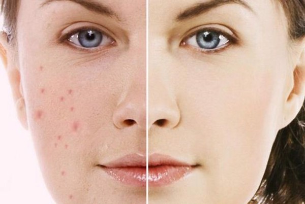Chăm sóc da mặt cho người bị mụn nên lưu ý gì?