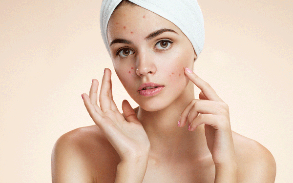 Chăm sóc da sau nặn mụn như thế nào tốt nhất?