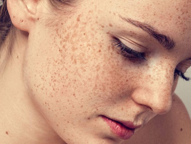 Uống collagen trị tàn nhang như thế nào để cải thiện làn da nhanh chóng?