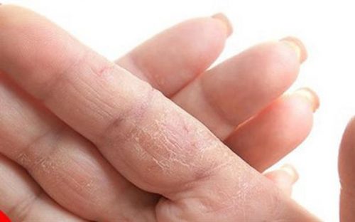Chăm sóc da đúng cách như thế nào để loại bỏ da tay khô