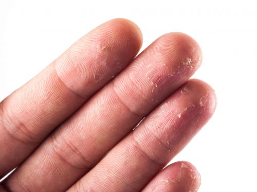 Chăm sóc da đúng cách như thế nào để loại bỏ da tay khô