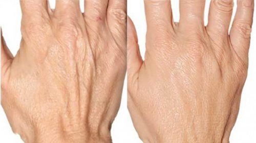 Tìm hiểu về da tay bị nhăn: Nguyên nhân và cách cải thiện