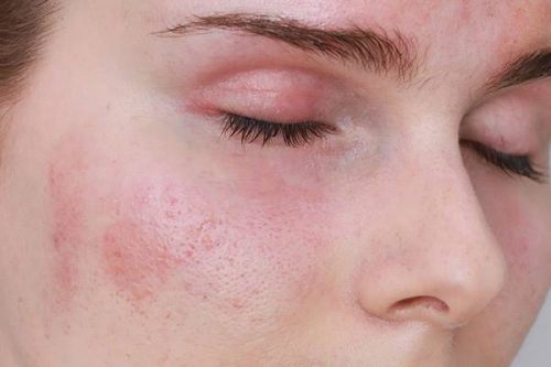 Dấu hiệu da mặt yếu - Làm thế nào để chăm sóc làn da yếu?