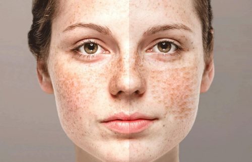 Nám da ở tuổi 20 - Nguyên nhân và cách khắc phục như thế nào?