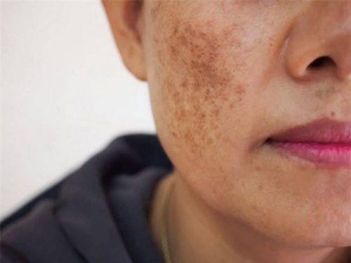 Mách bạn mặt nạ điều trị nám da cho phụ nữ tuổi trung niên từ thiên nhiên