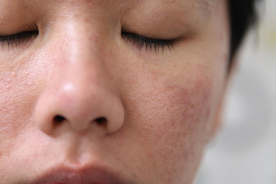 Bạn biết phải làm sao khi da mặt bị sần sùi tuổi 23 chưa?