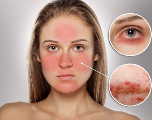 Bạn nên làm gì để bảo vệ da dễ kích ứng, nhạy cảm?