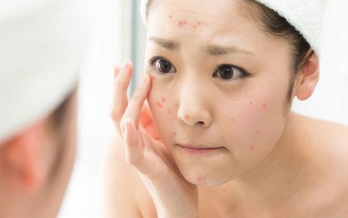 Bảo vệ da đúng cách khi bị mụn - Bạn nên làm gì và tránh gì?