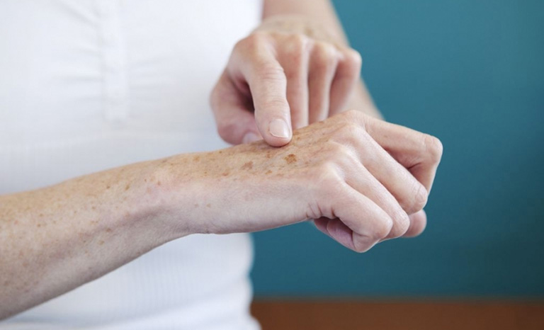 Cách chăm sóc da tay bị đồi mồi ở tuổi trung niên hiệu quả