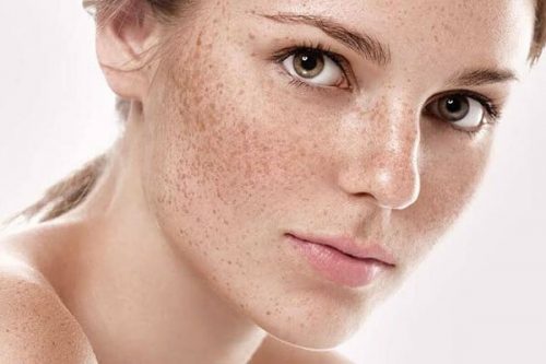 Nám chân sâu là gì? Uống collagen trị nám chân sâu có hiệu quả không?