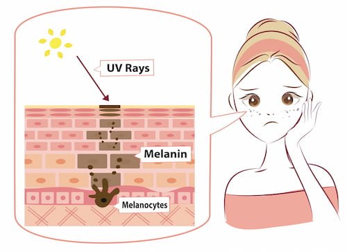 Giải đáp thắc mắc melanin có phải yếu tố gây nám da không?