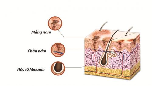 Giải đáp thắc mắc melanin có phải yếu tố gây nám da không?