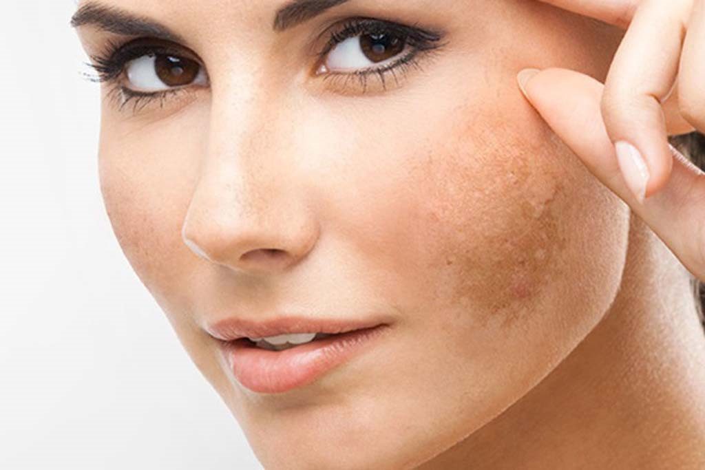 Những dấu hiệu cho biết da đang thiếu collagen cần bổ sung ngay