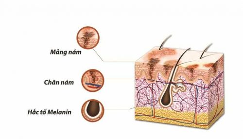 Tăng sắc tố da là gì? Nguyên nhân gây tăng sắc tố da