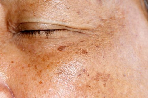 Bạn có biết nguyên nhân tăng sắc tố da ở tuổi 30 là gì?