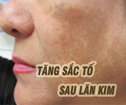 Làm cách nào để cải thiện da bị tăng sắc tố sau lăn kim