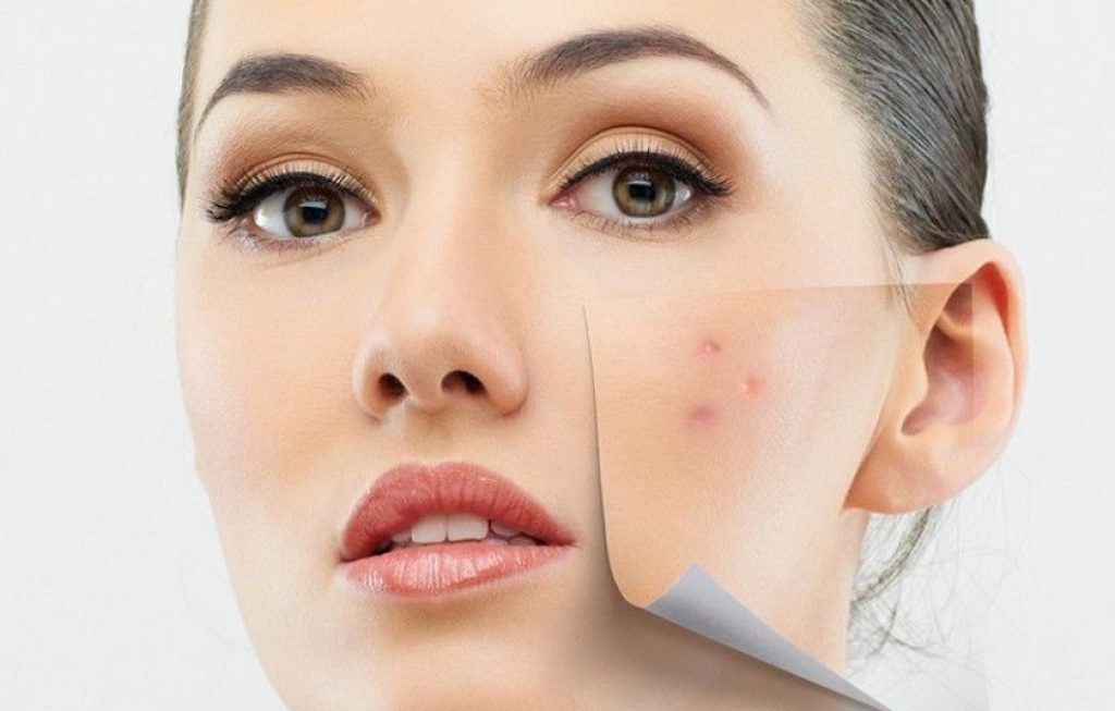 Skincare cho da mụn viêm cho tuổi 20 cần lưu ý gì?