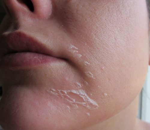 Làm cách nào để hạn chế da mặt sần sùi khô ráp ở tuổi 20?
