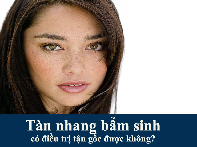 Tàn nhang bẩm sinh là gì? Có điều trị được không?