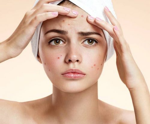 Bạn có biết nguyên nhân và cách chăm sóc da mụn nặng?