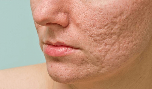 Cải thiện da mặt rỗ ở tuổi 50 bằng các công thức thiên nhiên