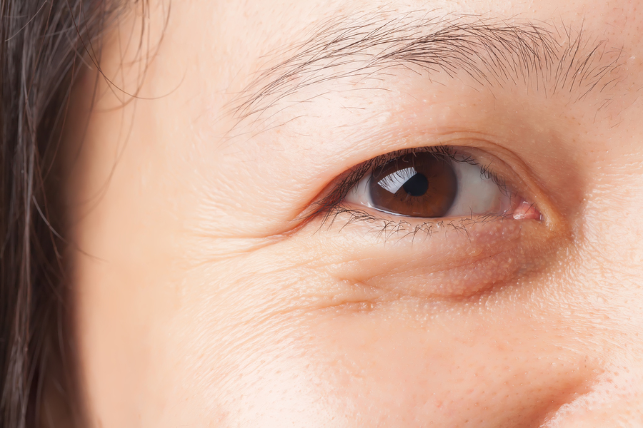 Bọng mắt chảy xệ tuổi 40: Nguyên nhân và cách khắc phục