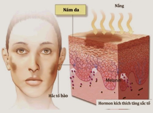 Làm cách nào để kiểm soát và ngăn ngừa nám da lan rộng?