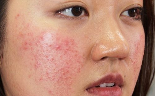 Những sai lầm khi skincare bị nổi mụn mà bạn cần biết