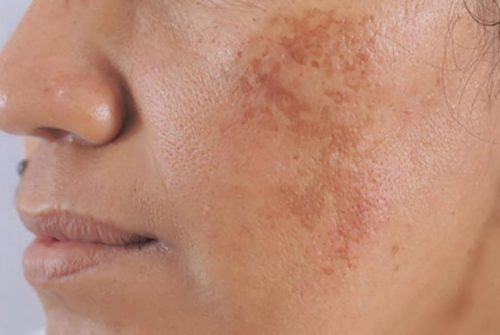 Nguyên nhân nám da là gì? Uống collagen tốt cho da nám không?