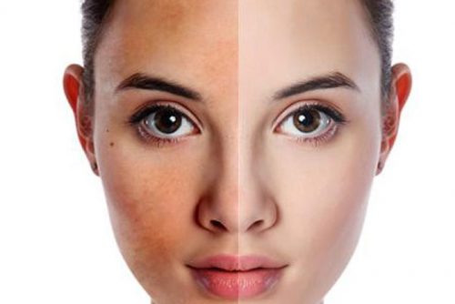 Làn da bị sạm màu dấu hiệu của lão hóa da -skinLift collagen