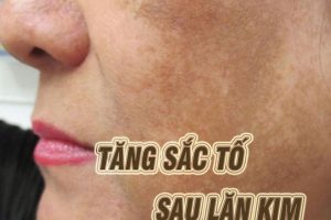 Làm cách nào để cải thiện da bị tăng sắc tố sau lăn kim