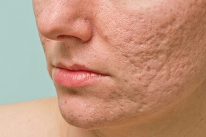 Cải thiện da mặt rỗ ở tuổi 50 bằng các công thức thiên nhiên