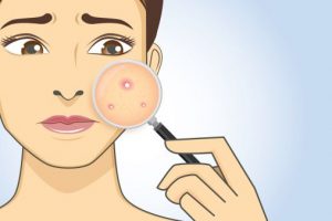 Giải đáp thắc mắc da mụn có nên uống collagen không?