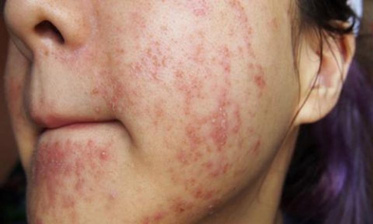 Nguyên nhân và cách cải thiện da mặt nổi nhiều mụn