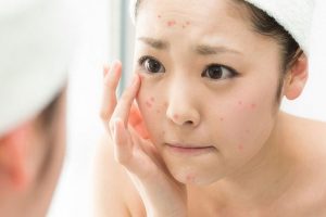 Trị mụn không cần skincare - Bạn có nên áp dụng cách này hay không?