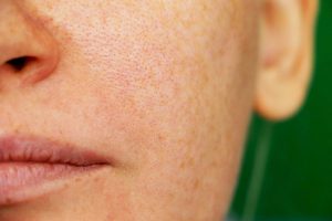 Tình trạng da mặt bị sần sùi sau sinh làm cách nào để cải thiện?