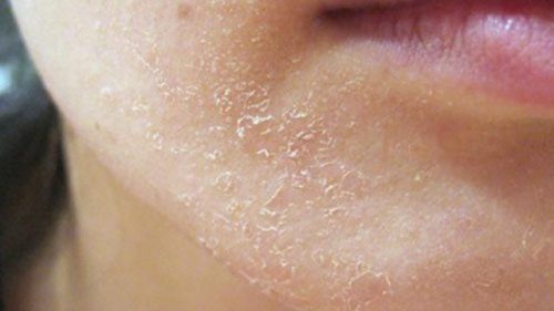 Tình trạng da mặt khô tróc vảy trắng bạn nên làm gì để cải thiện?