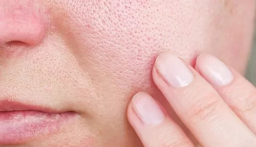 Các vấn đề về da mặt phổ biến hiện nay và cách xử lý hiệu quả