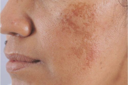 Những dấu hiệu tăng sắc tố da của tuổi 40 bạn cần biết!