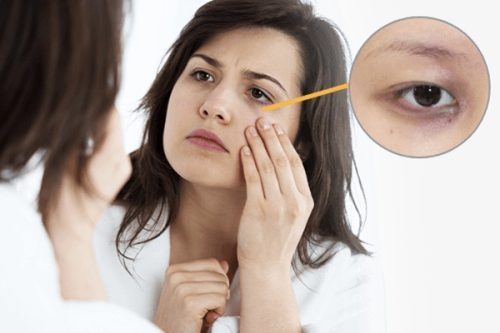 Quầng thâm mắt ở tuổi 40 - Nguyên nhân và cách cải thiện hiệu quả