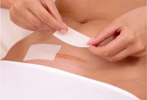 Cách chăm sóc da sau sinh mổ giúp vết thương nhanh lành