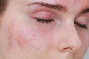 Giải pháp chăm sóc sau sinh da mặt bị khô ngứa hiệu quả