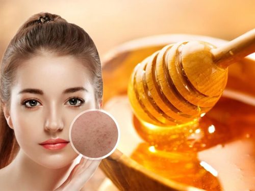 Bí quyết trị mụn cho bà bầu đơn giản tại nhà từ nguyên liệu thiên nhiên